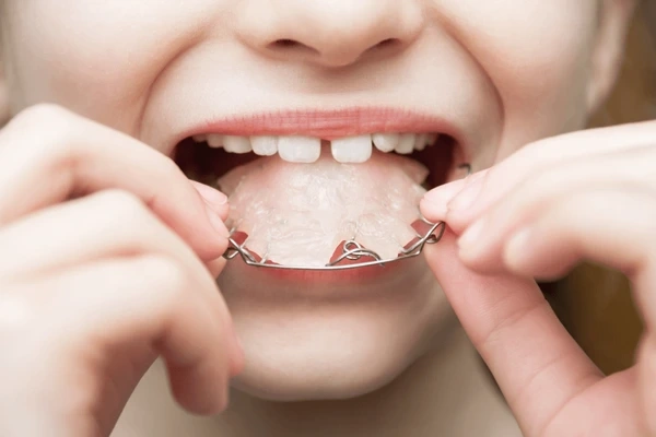 airway-focused orthodontics in walnut grove, bc