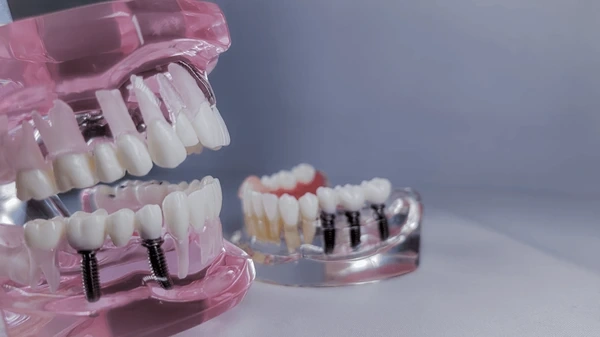 dental implants near you