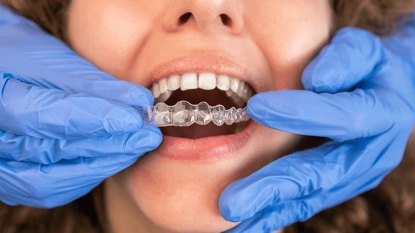 invisalign clear aligner treatment in walnut grove, bc